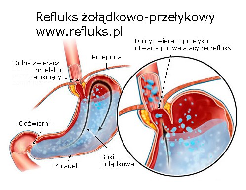Refluks żołądkowo przełykowy